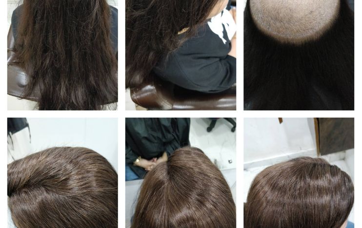Hair Patch in Faridabad